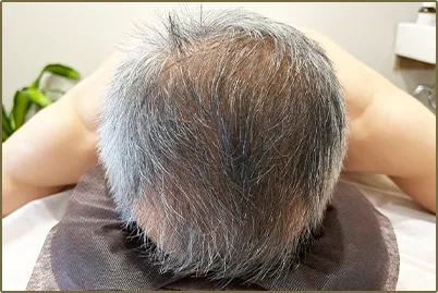鍼助の薄毛育毛鍼治療の特徴