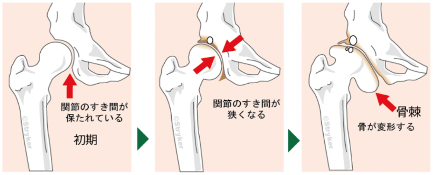 変形性股関節症の症状