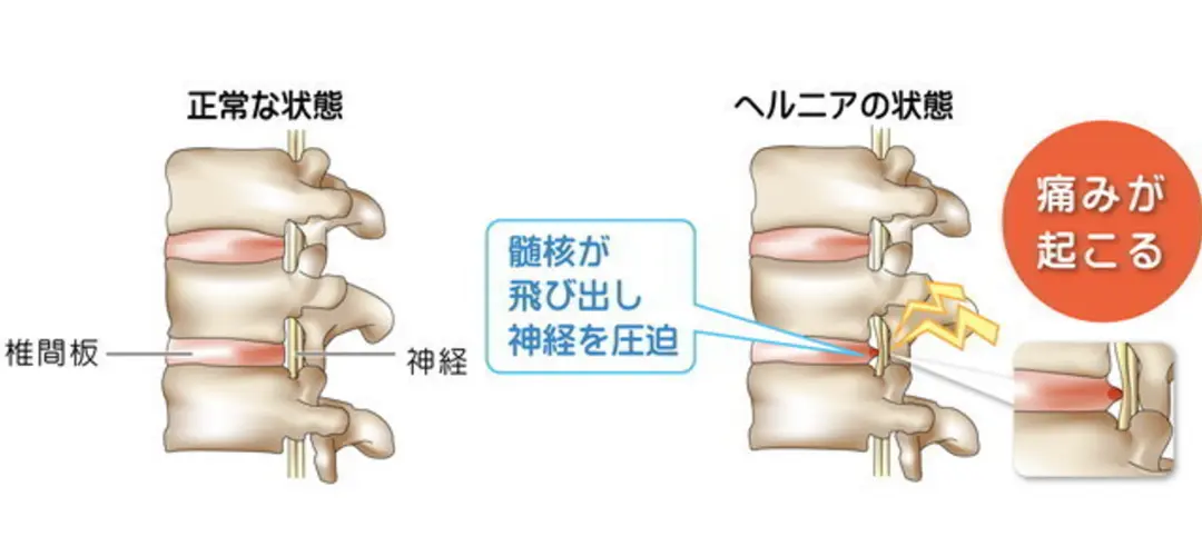 手根管症候群