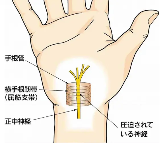 頸椎椎間板ヘルニア