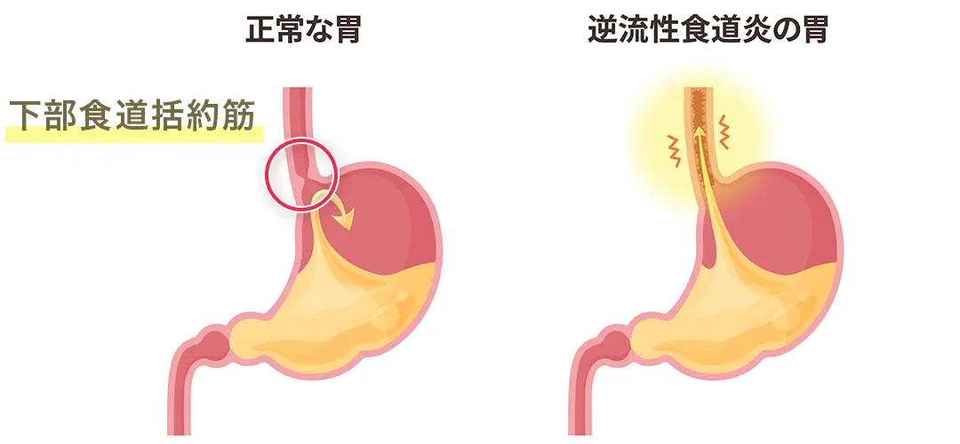 逆流性食道炎について鍼助での治療