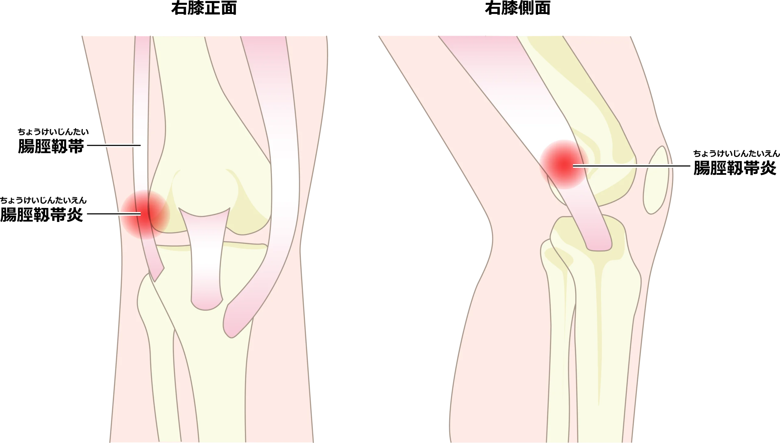 鵞腸脛靱帯が膝の骨と接する位置