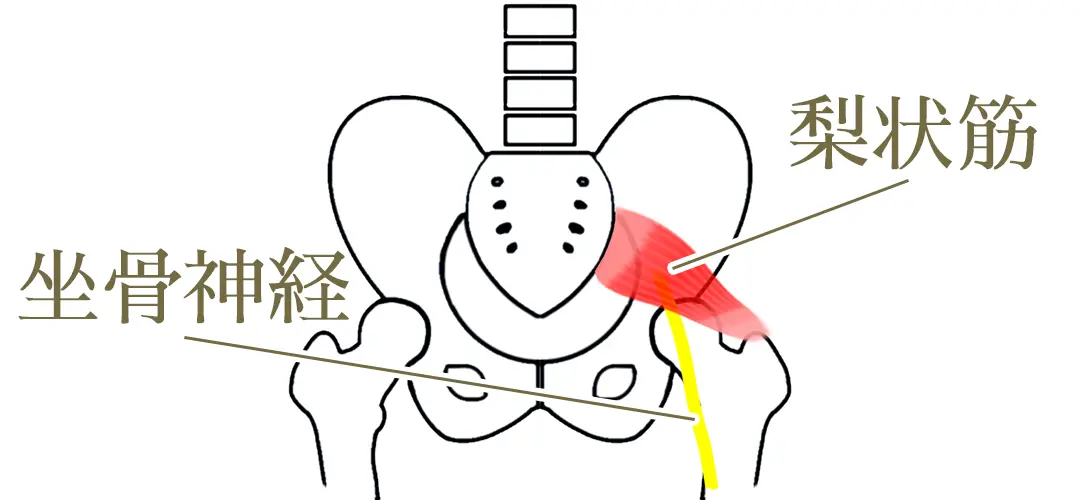梨状筋症候群